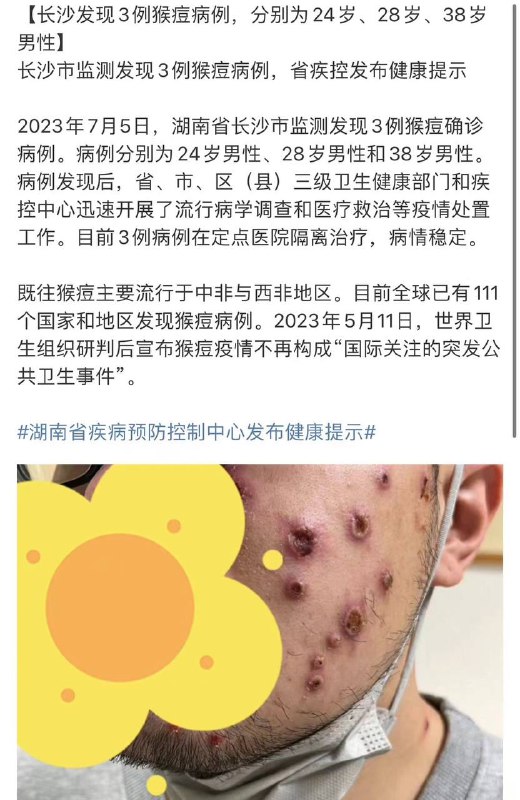#猴痘#猴痘