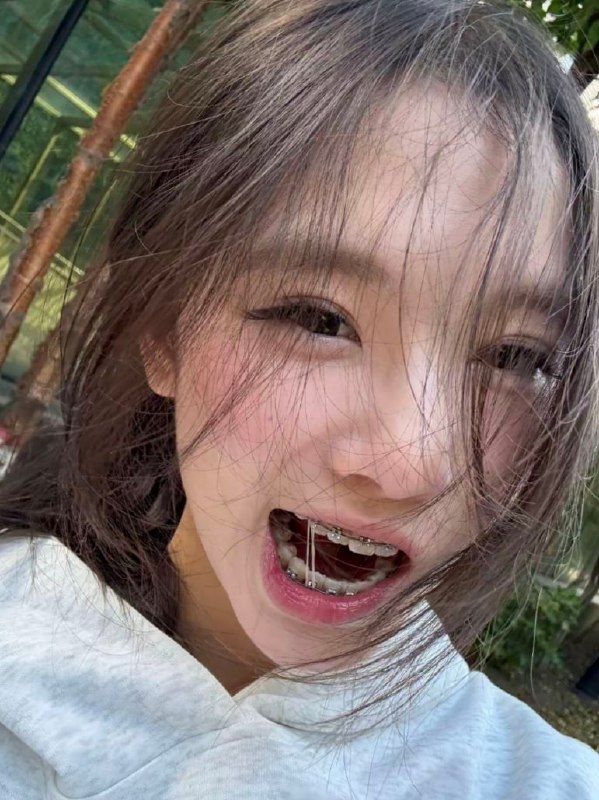 高校里戴牙套的女生，其实藏着不少加分项网上流传一个有趣的恋爱小观察：如果在学校里遇到戴牙套的女生，感觉合适的话，不妨认真对待