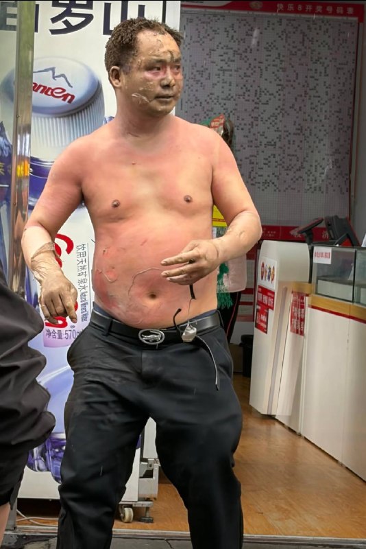 4月11日，湖南岳阳一男子煤气起火被烫伤，皮都掉了看着都疼感谢 Group  投稿！4月11日，湖南岳阳一男子煤气起火被烫伤，皮都掉了看着都疼感谢 Group  投稿！