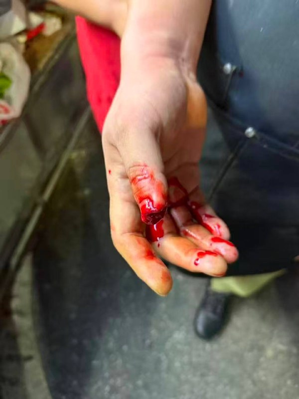 晚上摆摊纠纷 大妈把人家手指给咬断了比狗牙还锋利感谢家人们投稿！晚上摆摊纠纷 大妈把人家手指给咬断了比狗牙还锋利感谢家人们投稿！