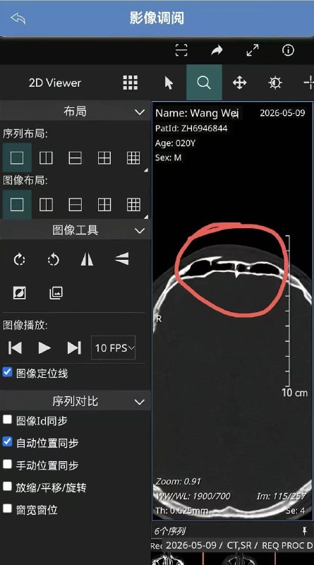 上个月，河北邯郸，某健身房内，一男子单边卸片，造成杠铃失衡砸中旁边小伙面部，致颅骨骨折
