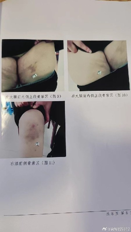 7月28日，恩施市人民法院一审以虐待罪判处罗某有期徒刑六个月，湖北恩施家暴受害者商文娟的经历再次引发关注