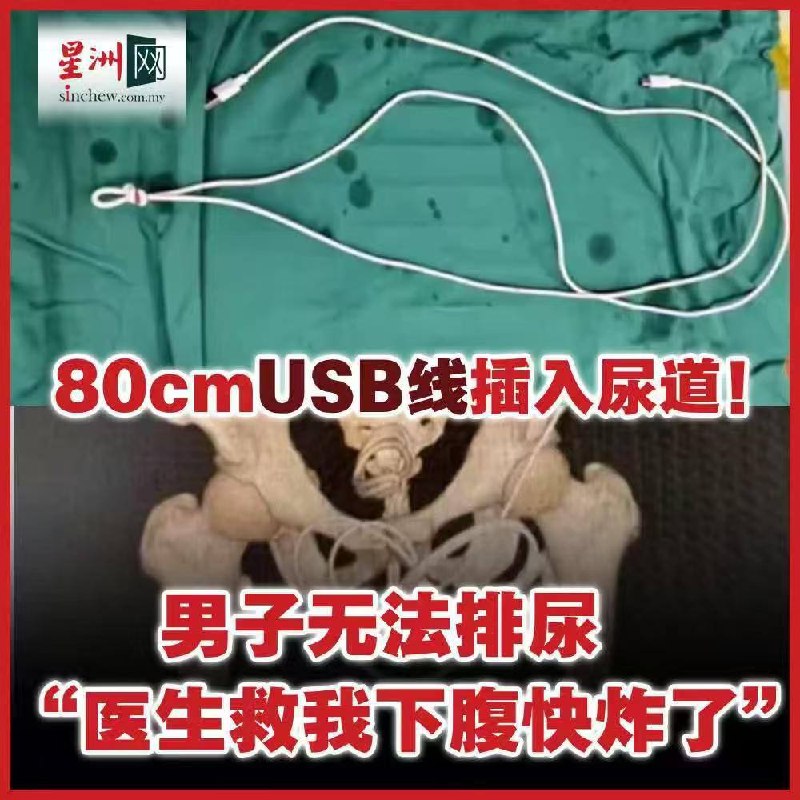 8OcmUSB线插入尿道！男子无法排尿“医生救我下腹快炸了