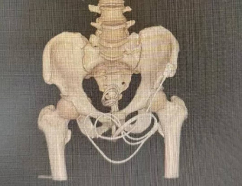 8OcmUSB线插入尿道！男子无法排尿“医生救我下腹快炸了