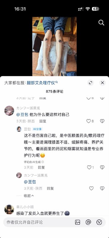 广东中山一名男子自学中医，每天用艾灸灼烧自己的双腿，并用视频记录下每天艾灸的过程以及身体变化