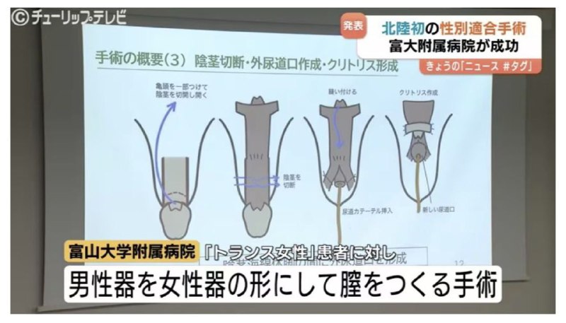 日本 一大学新研究的 手术 能把 男性 生殖器 改成 女性 生殖器 的 形状 #ts #男娘 崛起感谢家人们投稿！日本 一大学新研究的 手术 能把 男性 生殖器 改成 女性 生殖器 的 形状 #ts #男娘 崛起感谢家人们投稿！