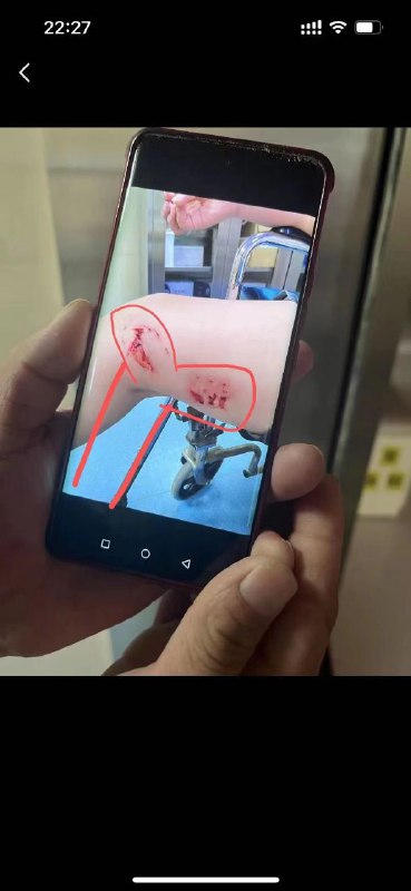 百度热搜榜TOP1广西 #北海 一浴场突发 #不明鱼类伤人事件，官方: 暂停涉水活动鱼？灯泡？百度热搜榜TOP1广西 #北海 一浴场突发 #不明鱼类伤人事件，官方: 暂停涉水活动鱼？灯泡？