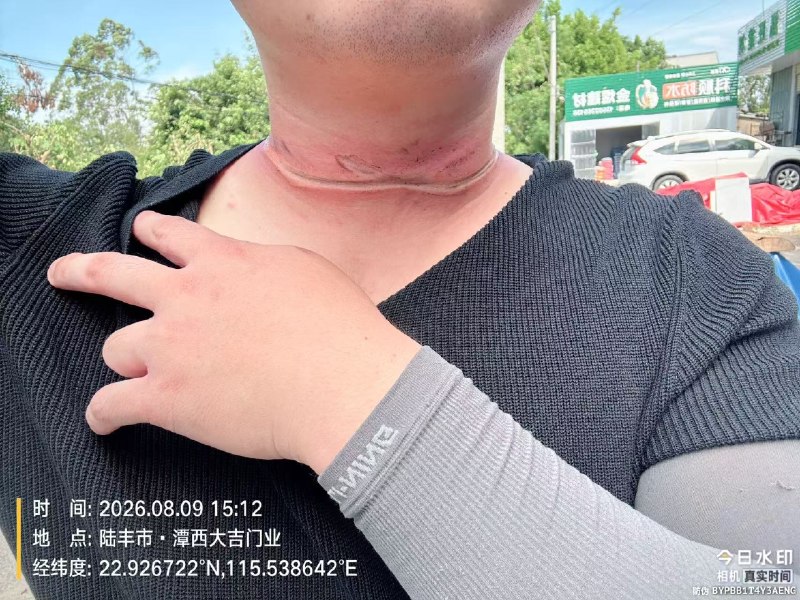 风筝线抹脖子，毁容了，没有十来万跑不了感谢家人们投稿！风筝线抹脖子，毁容了，没有十来万跑不了感谢家人们投稿！