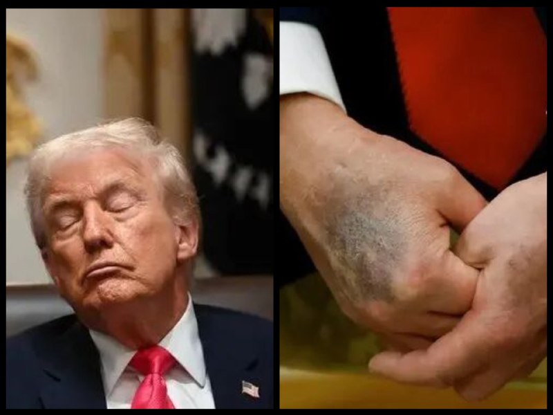 79 岁特朗普无视医嘱超量服药，频现老化迹象仍坚称健康完美《华尔街日报》独家报道，79 岁的特朗普正显现明显老化迹象：经常在公开活动中闭眼打盹，听力下降需要他人大声说话，皮肤脆弱易出血需用化妆品遮盖瘀伤