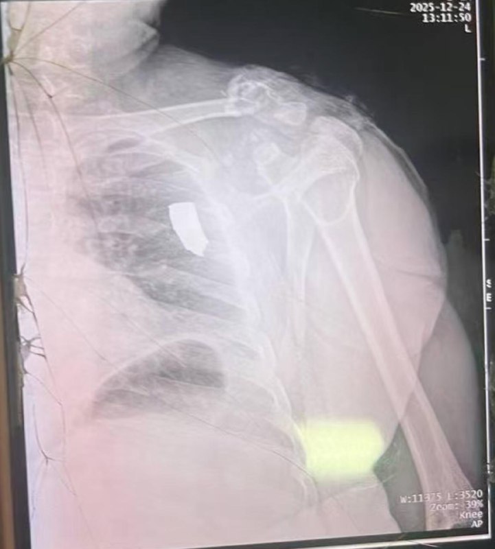 #网友投稿：昨天我兄弟让泰军给炸了！坐标波贝，昨天就在我们房子旁不远，柬军开着三辆坦克，躲在物业后面向泰军打炮，把我们中国人当肉盾