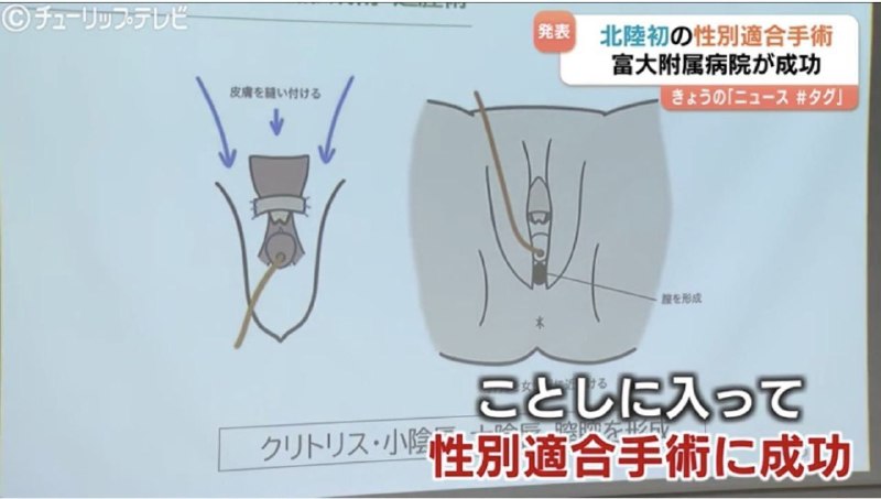 日本 一大学新研究的 手术 能把 男性 生殖器 改成 女性 生殖器 的 形状 #ts #男娘 崛起感谢家人们投稿！日本 一大学新研究的 手术 能把 男性 生殖器 改成 女性 生殖器 的 形状 #ts #男娘 崛起感谢家人们投稿！