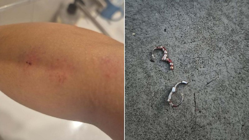 中国女子在澳大利亚遭种族主义袭击并被持刀威胁一名中国女子在澳大利亚首都堪培拉遭遇种族辱骂并被袭击，受伤流血后被送医治疗