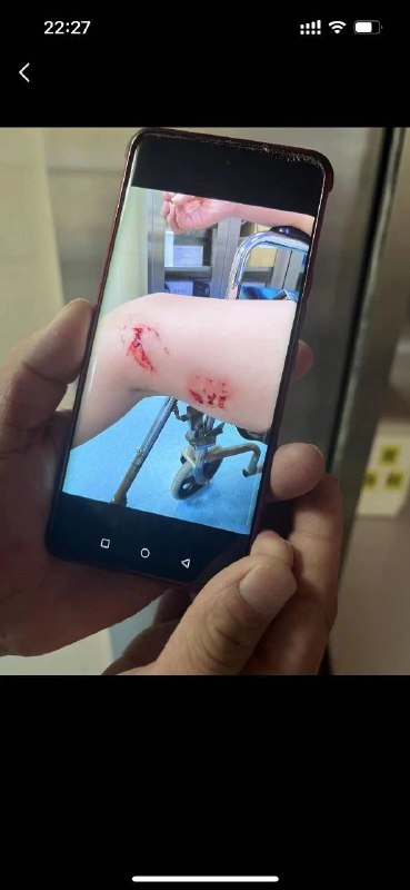 百度热搜榜TOP1广西 #北海 一浴场突发 #不明鱼类伤人事件，官方: 暂停涉水活动鱼？灯泡？百度热搜榜TOP1广西 #北海 一浴场突发 #不明鱼类伤人事件，官方: 暂停涉水活动鱼？灯泡？