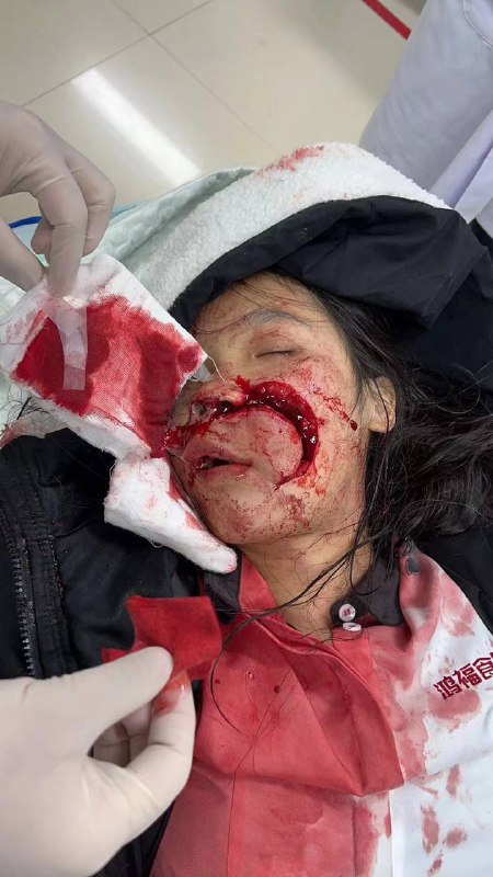 近日广西 河池 东兰 曲江路#车祸 汽车 🚗 撞护栏 #血腥 估计要 #毁容 了近日广西 河池 东兰 曲江路#车祸 汽车 🚗 撞护栏 #血腥 估计要 #毁容 了