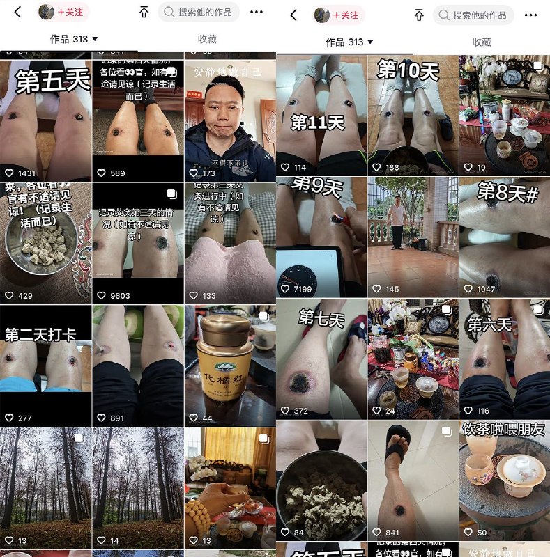 广东中山一名男子自学中医，每天用艾灸灼烧自己的双腿，并用视频记录下每天艾灸的过程以及身体变化