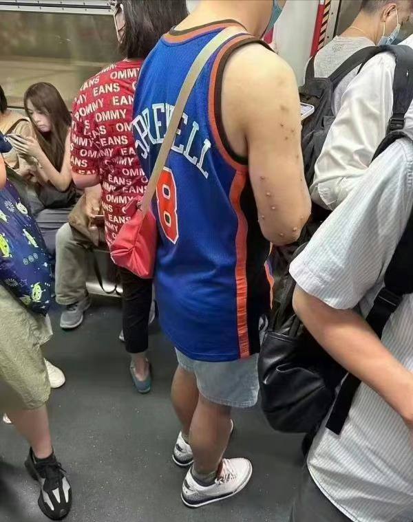 关于 #猴痘 需要了解的实用知识 #给子关于 #猴痘 需要了解的实用知识 #给子