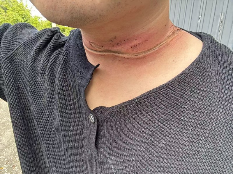 风筝线抹脖子，毁容了，没有十来万跑不了感谢家人们投稿！风筝线抹脖子，毁容了，没有十来万跑不了感谢家人们投稿！