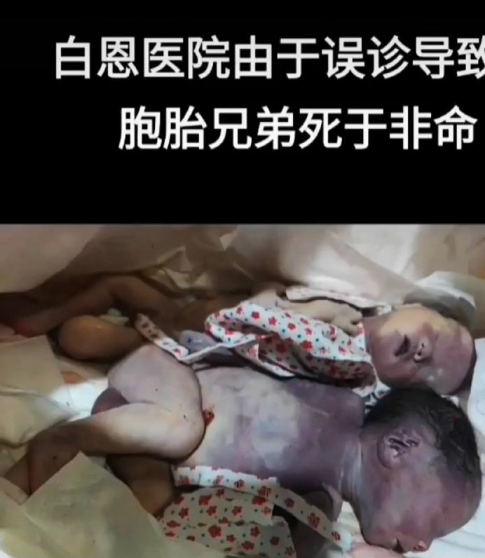 山西白球恩医院，两个未出世的双胞胎死了 #医疗纠纷山西白球恩医院，两个未出世的双胞胎死了 #医疗纠纷