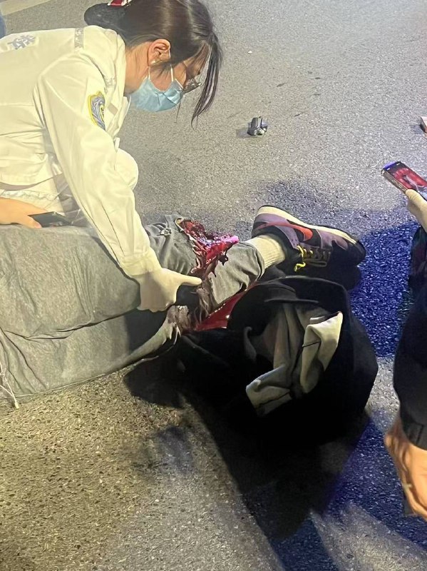 #摩托 #断腿 #车祸 #血腥 腿不见了 ？#摩托 #断腿 #车祸 #血腥 腿不见了 ？