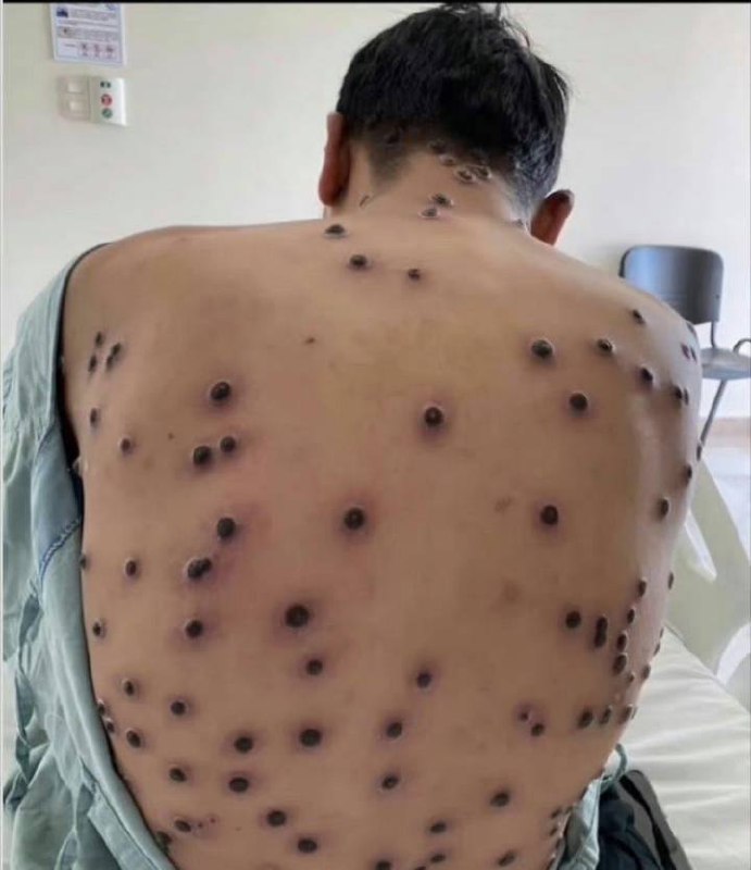 #猴痘by 匿名投稿