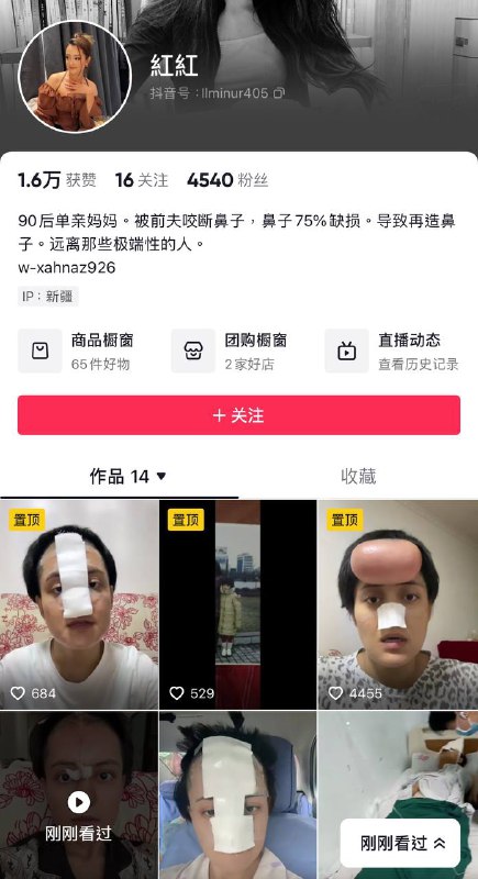 #新疆 被前夫咬掉鼻子 👃植皮by 匿名投稿#新疆 被前夫咬掉鼻子 👃植皮by 匿名投稿