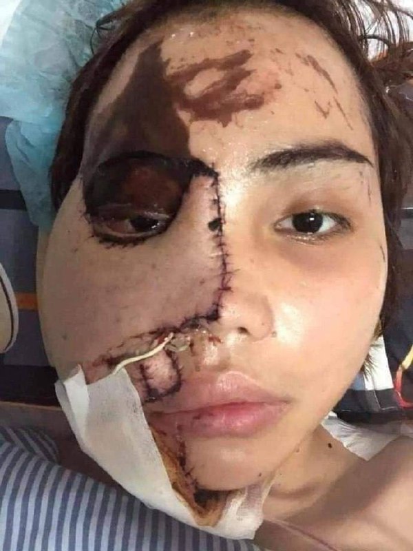 事发 #柬埔寨🇰🇭 女子被丈夫泼了硫酸... ​​​by 匿名投稿事发 #柬埔寨🇰🇭 女子被丈夫泼了硫酸... ​​​by 匿名投稿