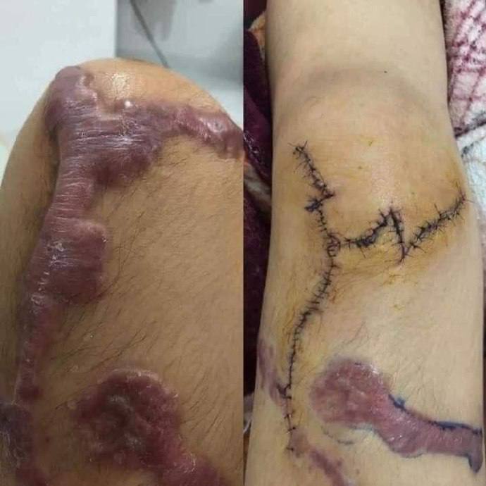 事发 #柬埔寨🇰🇭 女子被丈夫泼了硫酸... ​​​by 匿名投稿事发 #柬埔寨🇰🇭 女子被丈夫泼了硫酸... ​​​by 匿名投稿