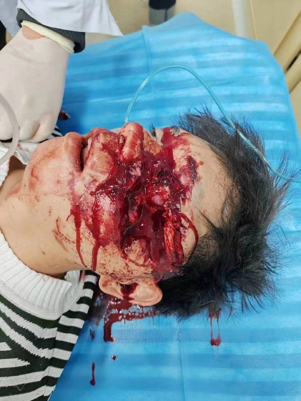 近日广西 河池 东兰 曲江路#车祸 汽车 🚗 撞护栏 #血腥 估计要 #毁容 了近日广西 河池 东兰 曲江路#车祸 汽车 🚗 撞护栏 #血腥 估计要 #毁容 了