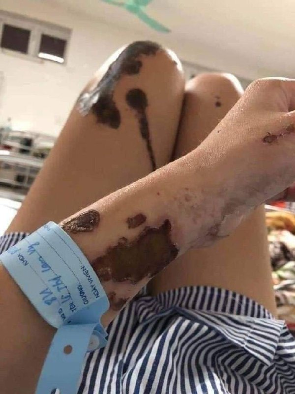 事发 #柬埔寨🇰🇭 女子被丈夫泼了硫酸... ​​​by 匿名投稿事发 #柬埔寨🇰🇭 女子被丈夫泼了硫酸... ​​​by 匿名投稿