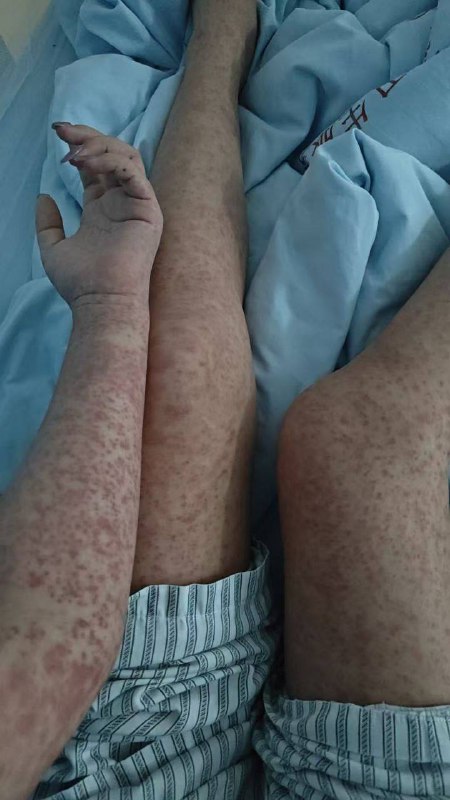 广州  基孔 肯雅热 #蚊子 #疫情感谢来自某频道的投稿！广州  基孔 肯雅热 #蚊子 #疫情感谢来自某频道的投稿！