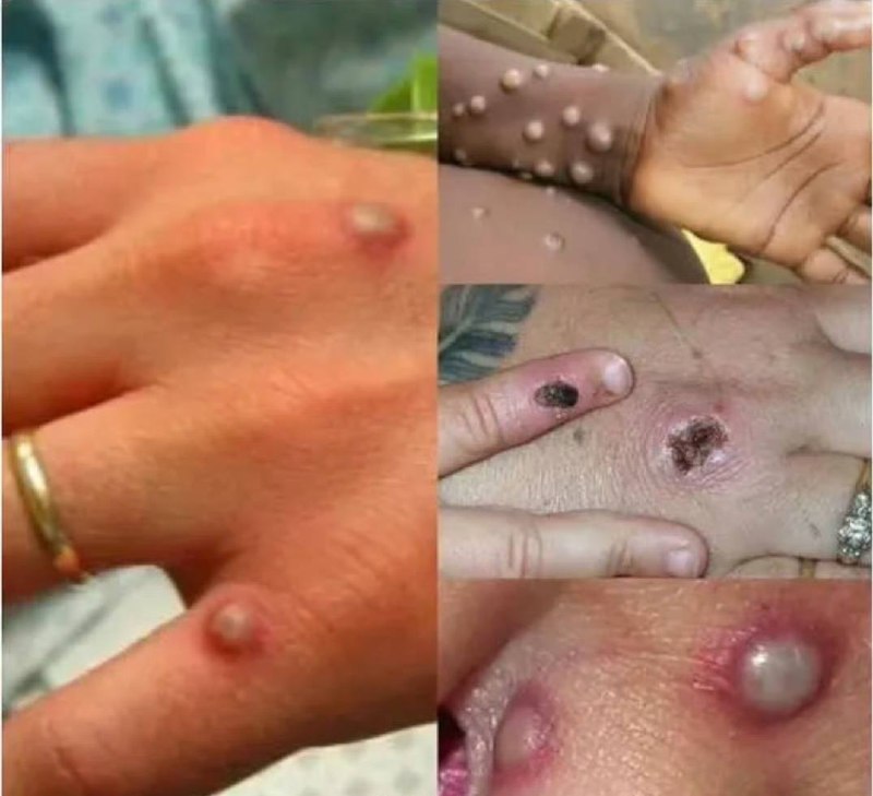 已有152例 #猴痘 病例死亡，死亡率不高，但很恶心by 匿名投稿