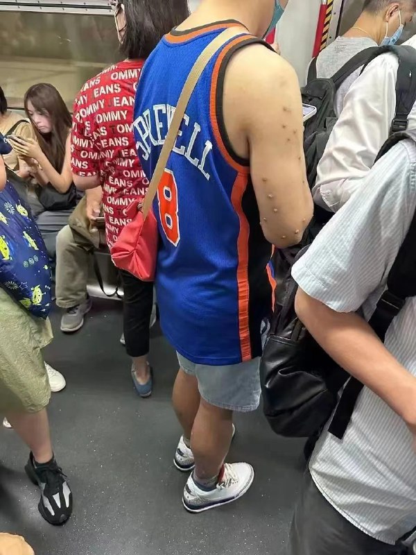 #同性恋 #猴痘#同性恋 #猴痘