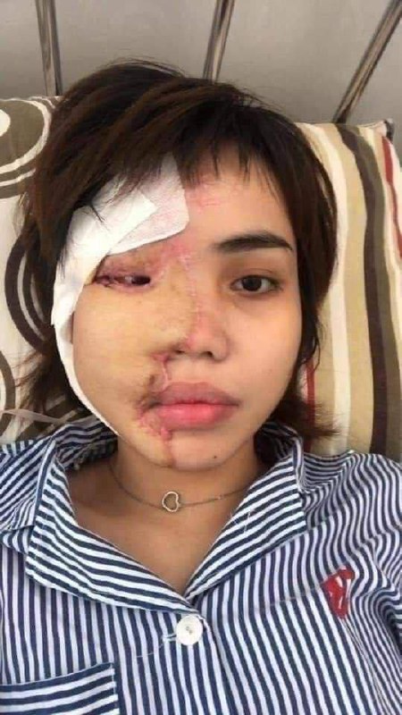 事发 #柬埔寨🇰🇭 女子被丈夫泼了硫酸... ​​​by 匿名投稿事发 #柬埔寨🇰🇭 女子被丈夫泼了硫酸... ​​​by 匿名投稿