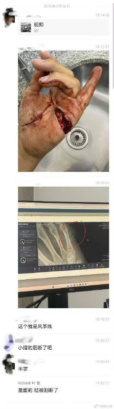 #摩托 #车祸 ✋ 受伤了#摩托 #车祸 ✋ 受伤了