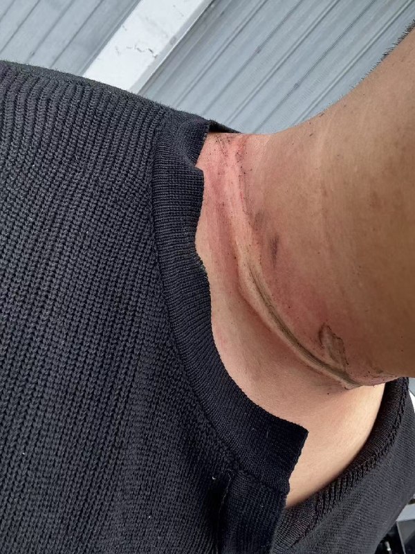 风筝线抹脖子，毁容了，没有十来万跑不了感谢家人们投稿！风筝线抹脖子，毁容了，没有十来万跑不了感谢家人们投稿！